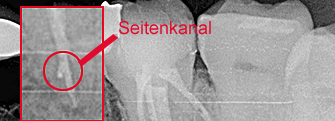 Endodontie - Wurzelbehandlung